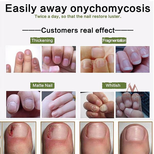 NAIL TREATMENT CREAM - Exinoz